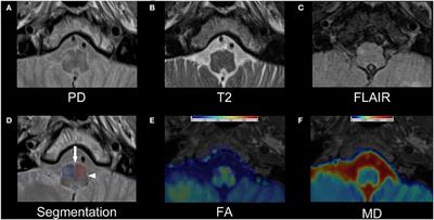 Qualitative and quantitative detectability of hypertrophic olivary degeneration in T2, FLAIR, PD, and DTI: A prospective MRI study